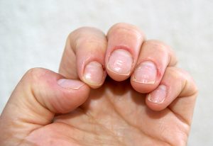 Gluten hassasiyetinin 8 belirtisi