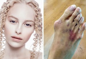 Gluten hassasiyetinin 8 belirtisi